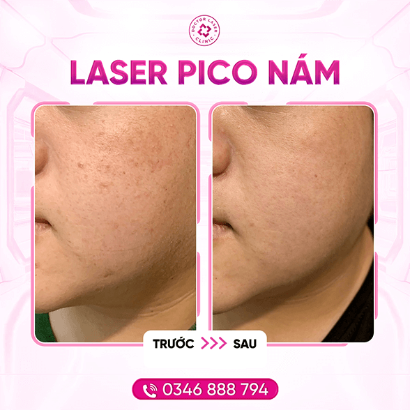 Việt_18.4.24_pico nám