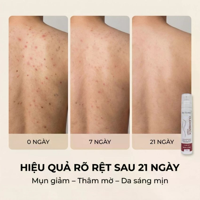 kết quả giảm mụn lưng sau 21 ngày drclariv kết quả giảm mụn lưng sau 21 ngày drclariv