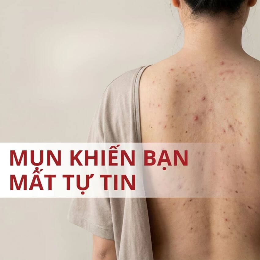 mụn lưng khiến bạn mất tự tin mụn lưng khiến bạn mất tự tin