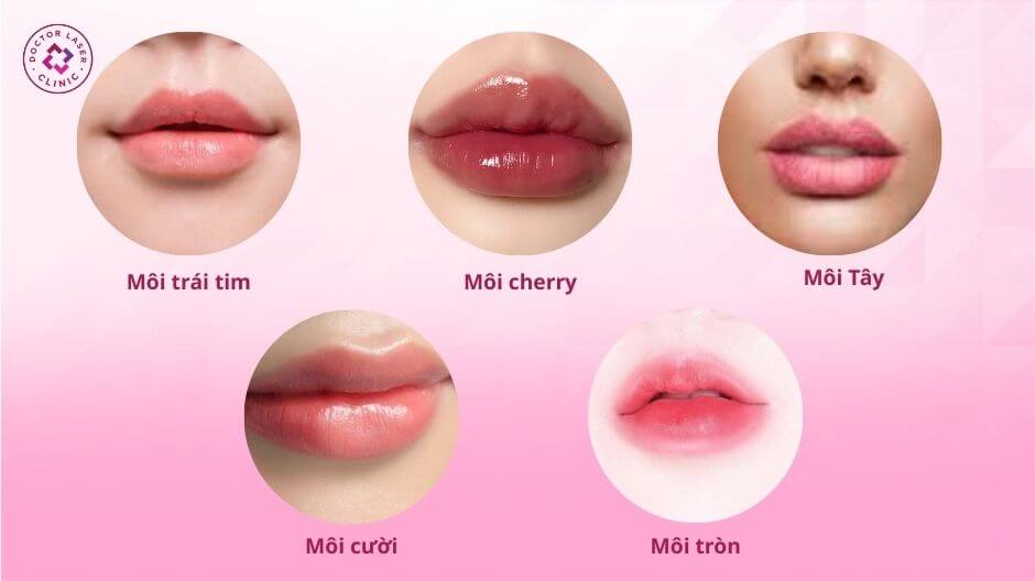 5 dáng môi filler cho môi dày