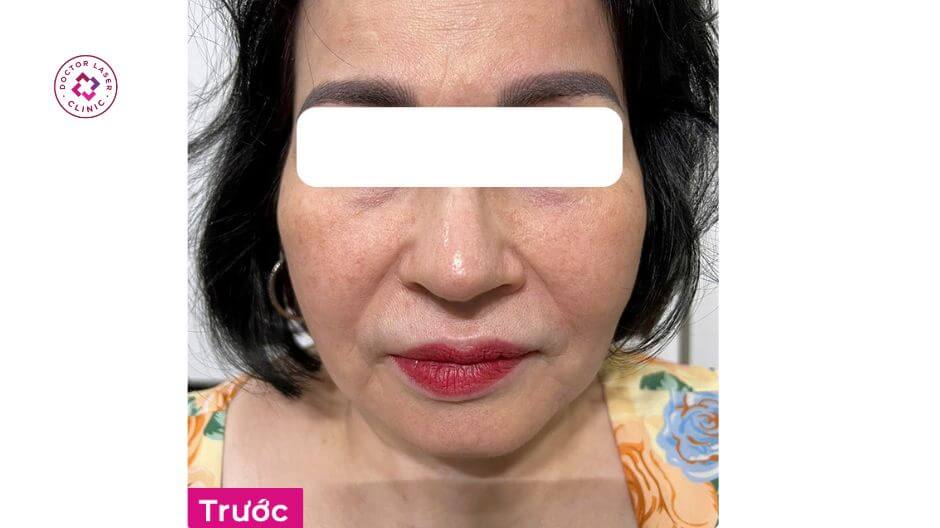 ảnh trước rãnh cười sâu