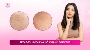 sẹo đáy nhọn và lỗ chân lông to