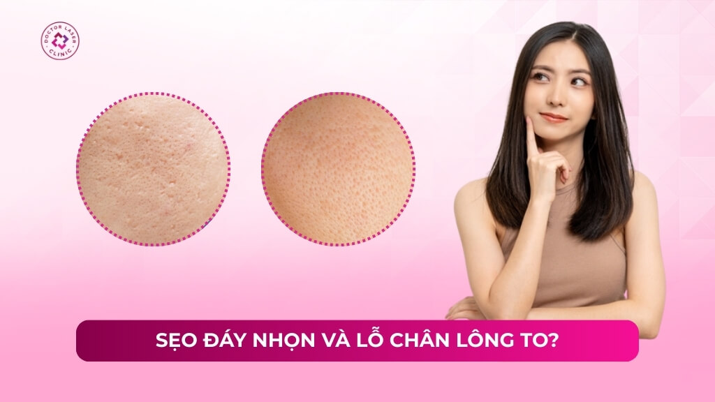 sẹo đáy nhọn và lỗ chân lông to sẹo đáy nhọn và lỗ chân lông to
