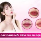 Các dáng môi tiêm filler đẹp tự nhiên và xu hướng tạo hình hiện nay