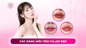các dáng môi tiêm filler đẹp