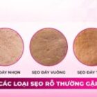 Nhận diện các loại sẹo rỗ thường gặp kèm hình ảnh cụ thể