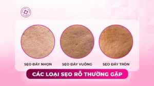 các loại sẹo rỗ thường gặp