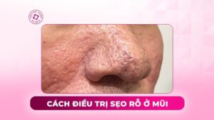 cách điều trị sẹo rỗ ở mũi cách điều trị sẹo rỗ ở mũi