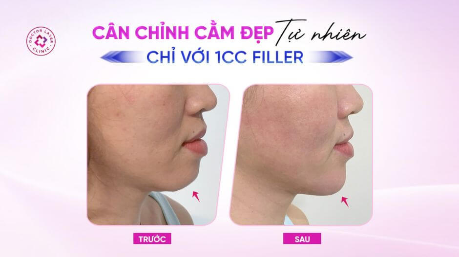 cằm lẹm sau cân chỉnh