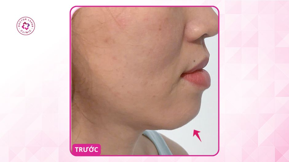 cằm lẹm trước cân chỉnh