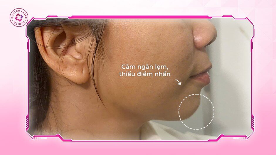 cằm ngắn lẹm thiếu điểm nhấn