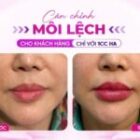 Cân chỉnh môi lệch an toàn chuẩn y khoa