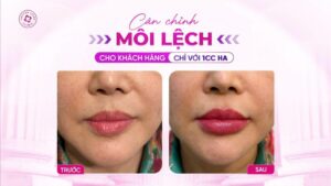 cân chỉnh môi lệch an toàn chuẩn y khoa