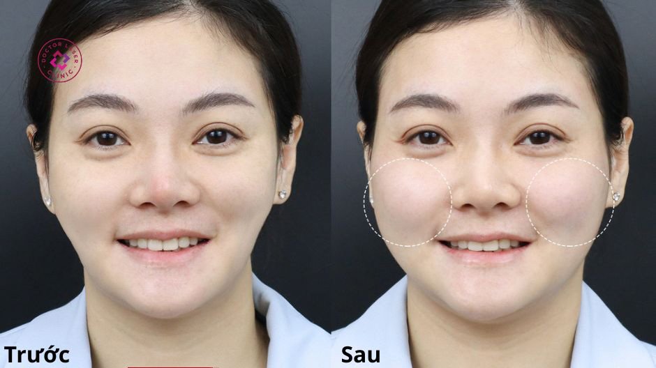 chỉ định tiêm filler má trước sau hiệu quả