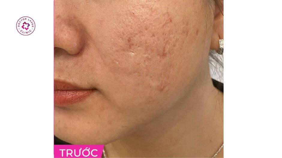 chị nhi trước khi điều trị sẹo