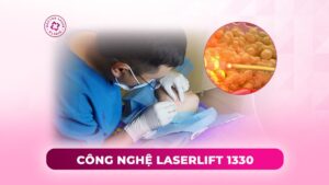 công nghệ laserlift 1330 công nghệ laserlift 1330