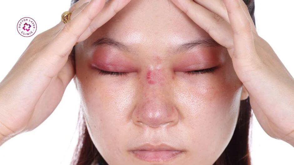 dấu hiệu cảnh báo tiêm filler trúng mạch vùng mắt