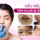 Dấu hiệu tiêm filler bị hoại tử và hướng dẫn xử lý hiệu quả