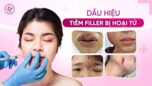 dấu hiệu tiêm filler bị hoại tử dấu hiệu tiêm filler bị hoại tử