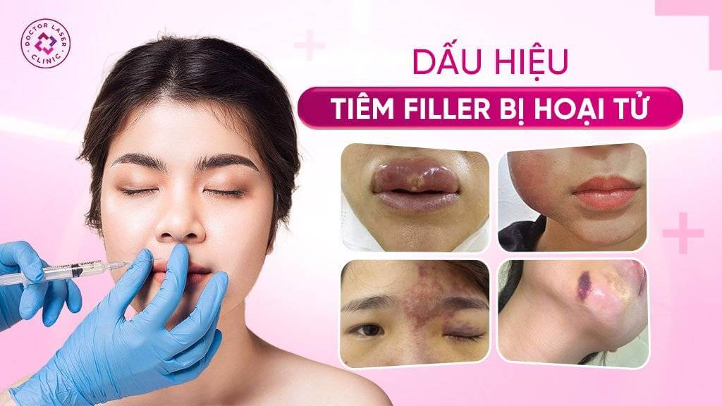 dấu hiệu tiêm filler bị hoại tử