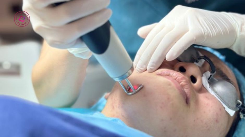 điều trị bằng laser