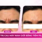 Tiêm filler cau mày giúp gương mặt nam giới thư giãn hơn
