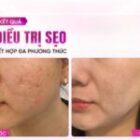 Nếu chăm da sớm đâu phải chịu sẹo 10 năm