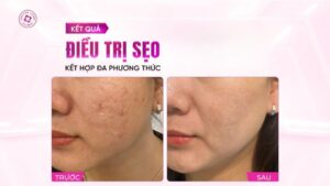 Nếu chăm da sớm đâu phải chịu sẹo 10 năm