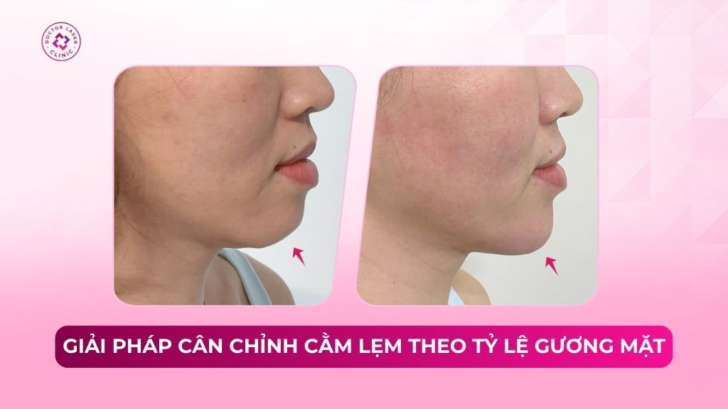 giải pháp cân chỉnh cằm lẹm theo tỷ lệ gương mặt