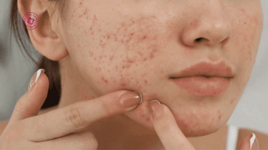 hạn chế nặn mụn tại nhà