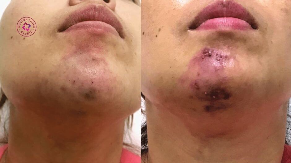 hoại tử filler vùng cằm triệu chứng nhận biết