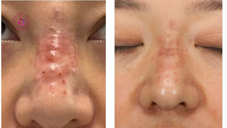 hoại tử sau tiêm filler vùng mũi