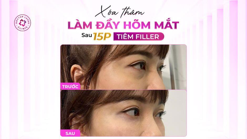 hõm mắt sau tiêm filler