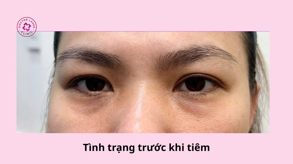 hõm mắt sâu trước tiêm filler