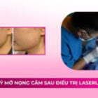 Huỷ mỡ nọng cằm sau điều trị Laserlift