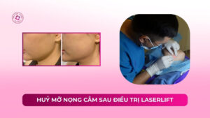 Huỷ mỡ nọng cằm sau điều trị Laserlift