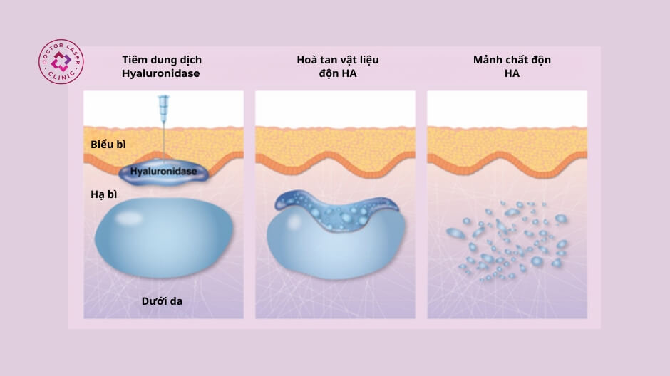 hyaluronidase phân giải filler cơ chế