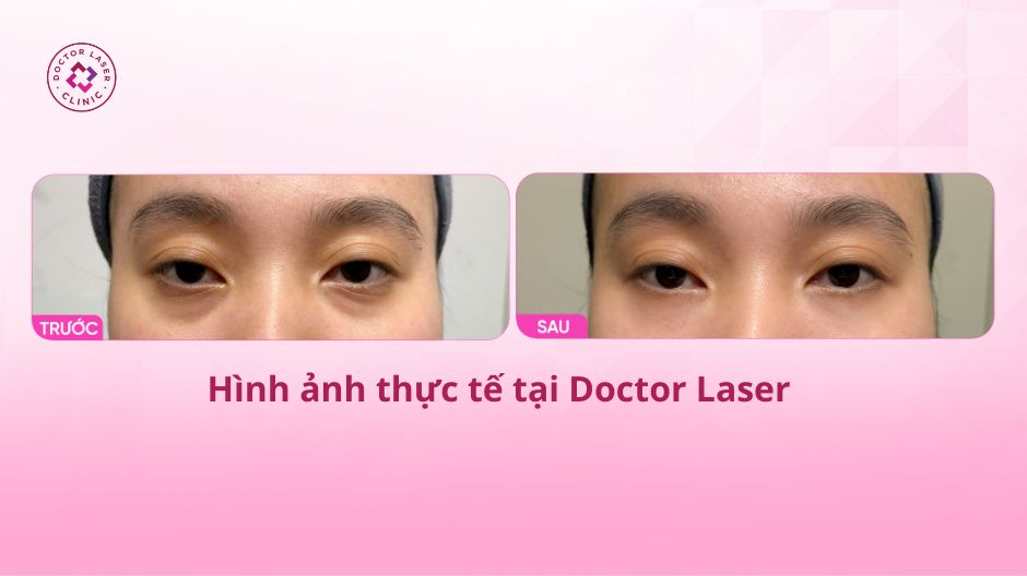 kết quả ngay sau tiêm filler quầng thâm mắt