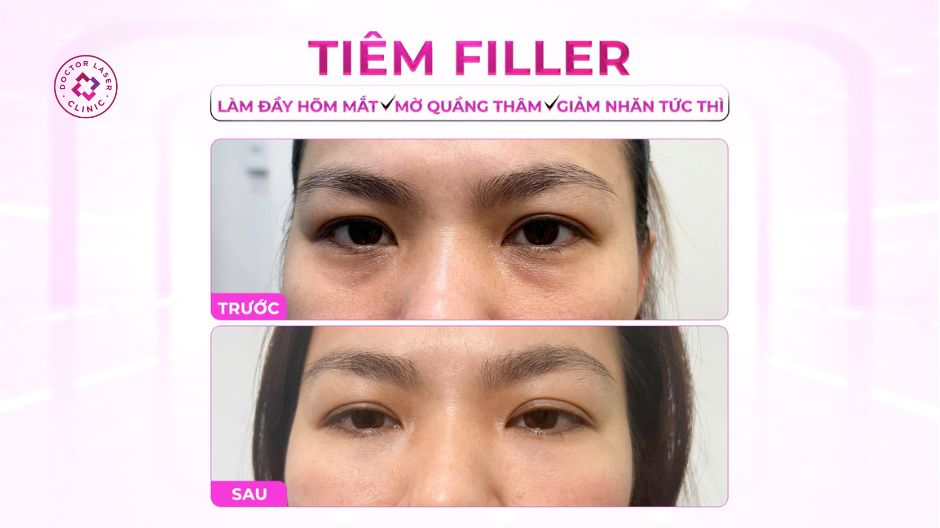 kết quả sau điều chỉnh hõm mắt trước sau