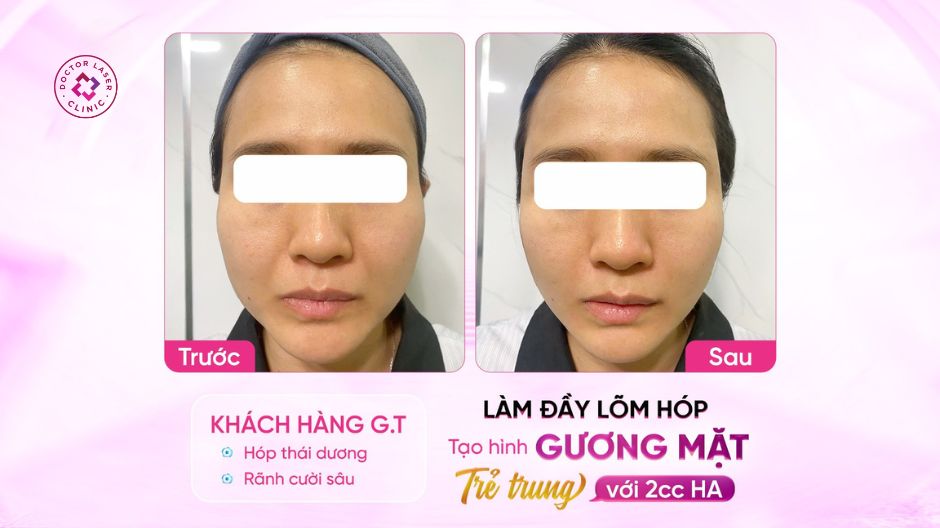 kết quả điều chỉnh thái dương rãnh cười