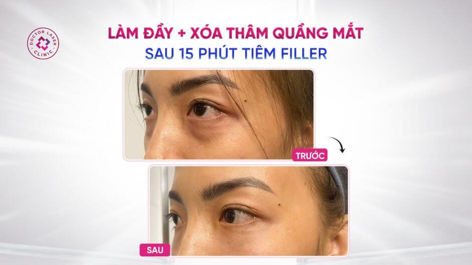 kết quả sau tiêm filler cải thiện hõm mắt