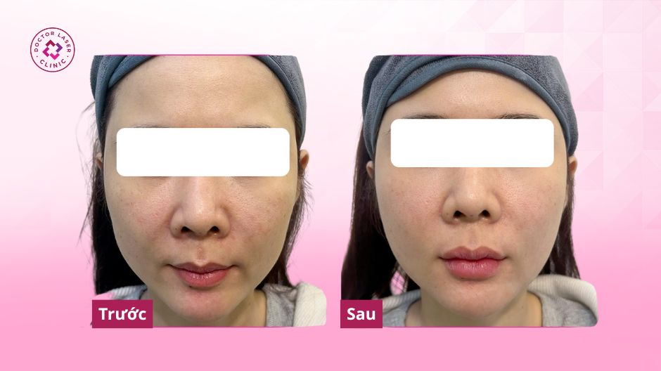 khách hàng trước sau tiêm filler môi trái tim