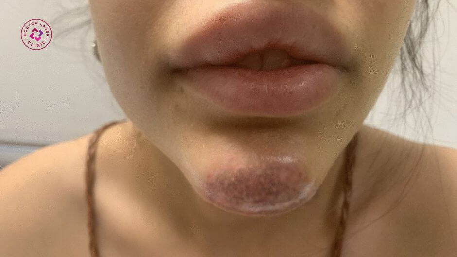 khối cứng nổi cục sau tiêm filler 1 năm