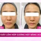 Làm đầy lõm hóp gương mặt bằng 2cc HA
