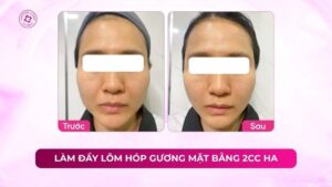 làm đầy lõm hóp gương mặt bằng 2cc ha