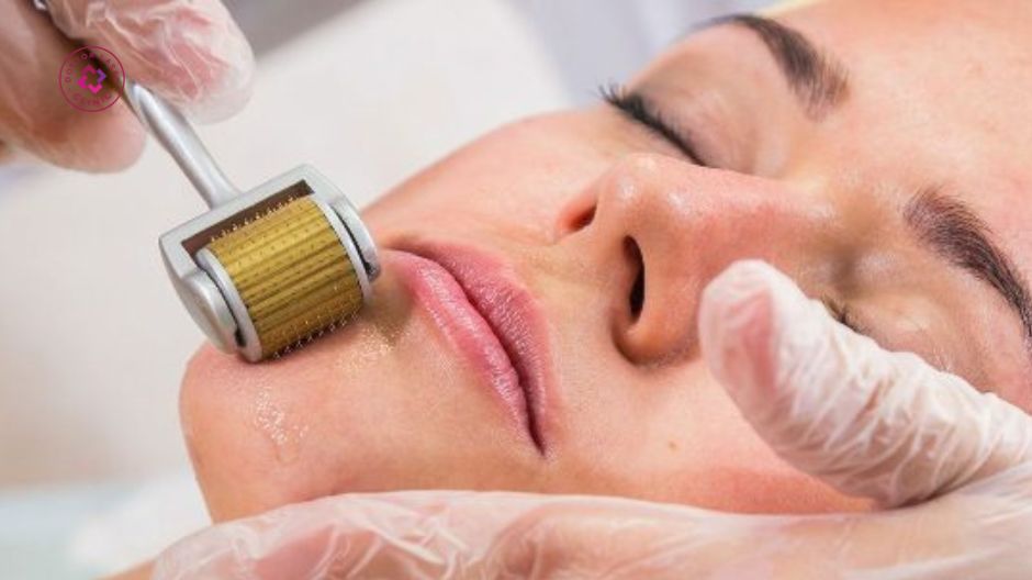 lăn kim điều trị sẹo rỗ