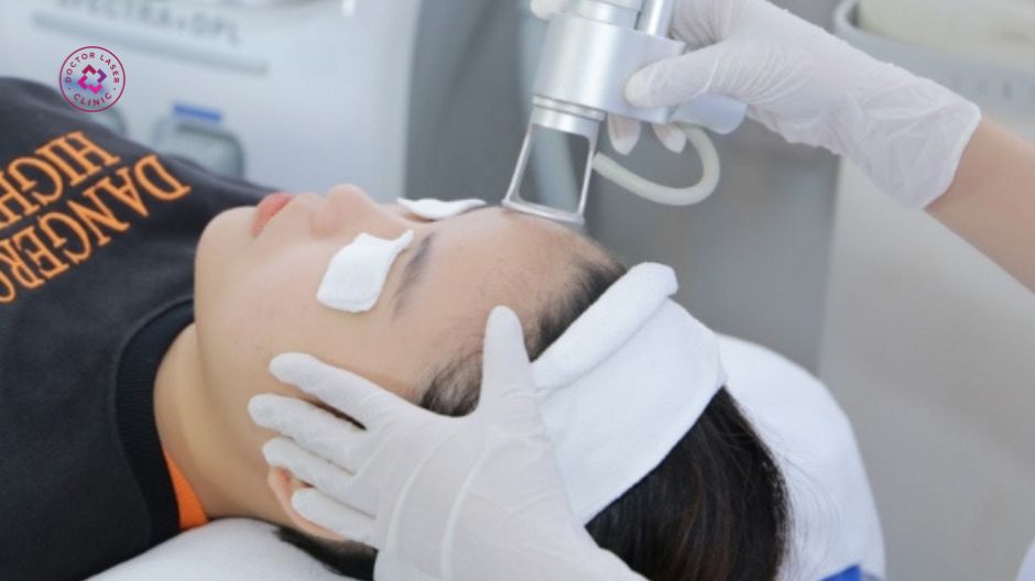 liệu pháp laser điều trị sẹo lõm đáy vuông