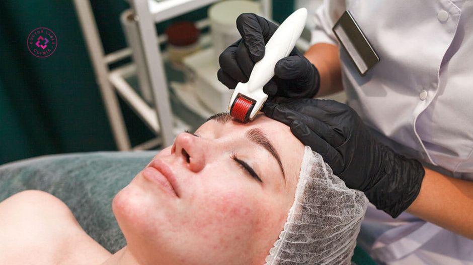 liệu trình lăn kim