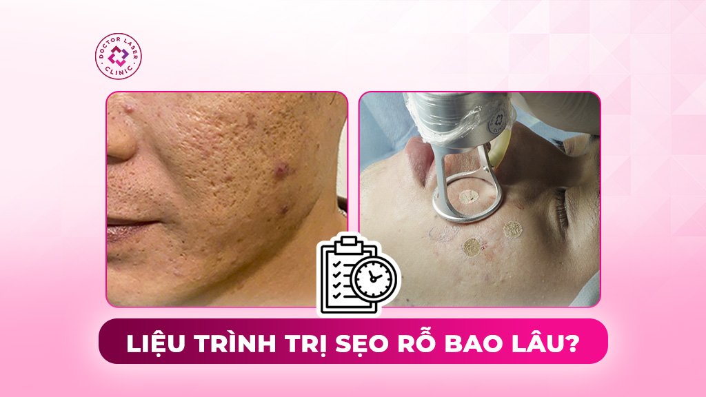 liệu trình trị sẹo rỗ bao lâu