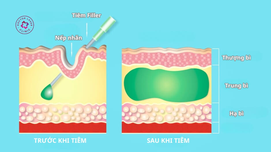 minh hoạ tiêm chất làm đầy filler trước và sau